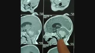 تومور مغزی شیرخوار