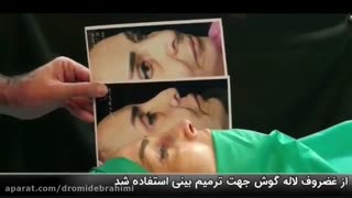 عمل ترمیم بینی با استفاده از غضروف لاله گوش توسط دکتر امید ابراهیمی