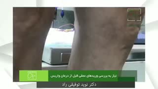 واریس خیلی شدید