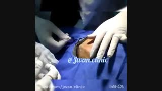 لیفت و قرینه سازی ابروهای نامتقارن با نخ
