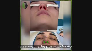 عمل همزمان آندوسکوپی سینوس و زیبایی بینی به فرم Natural Cute | دکتر باستانی نژاد