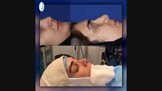 بلافاصله بعد از جراحی زیبایی بینی | متخصص گوش و حلق و بینی | دکتر محمد گلی
