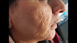 دکتر فریدون اسفندیاری در کرمانشاه لیزر صورت
