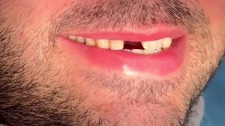 تاثیر ایمپلنت بر زیبایی خصوصا در دندانها جلو
