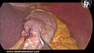 برداشتن گوه ای لاپاروسکوپی برای GIST معده