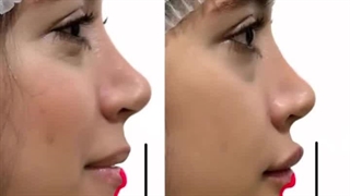 تزریق فیلر چانه و لب به سبک دکتر علی پرتویی نژاد