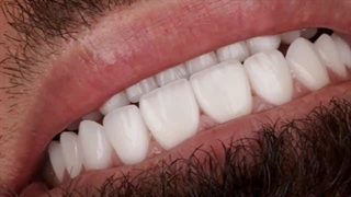 مراحل طراحی لبخند