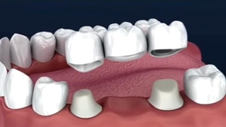 شماتیک بریج دندانی