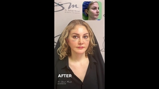 عملیة شد الوجه والرقبة - بعد 15 یومًا من الجراحة